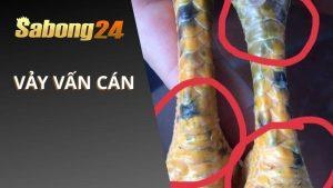 Vảy Gà Vấn Cán